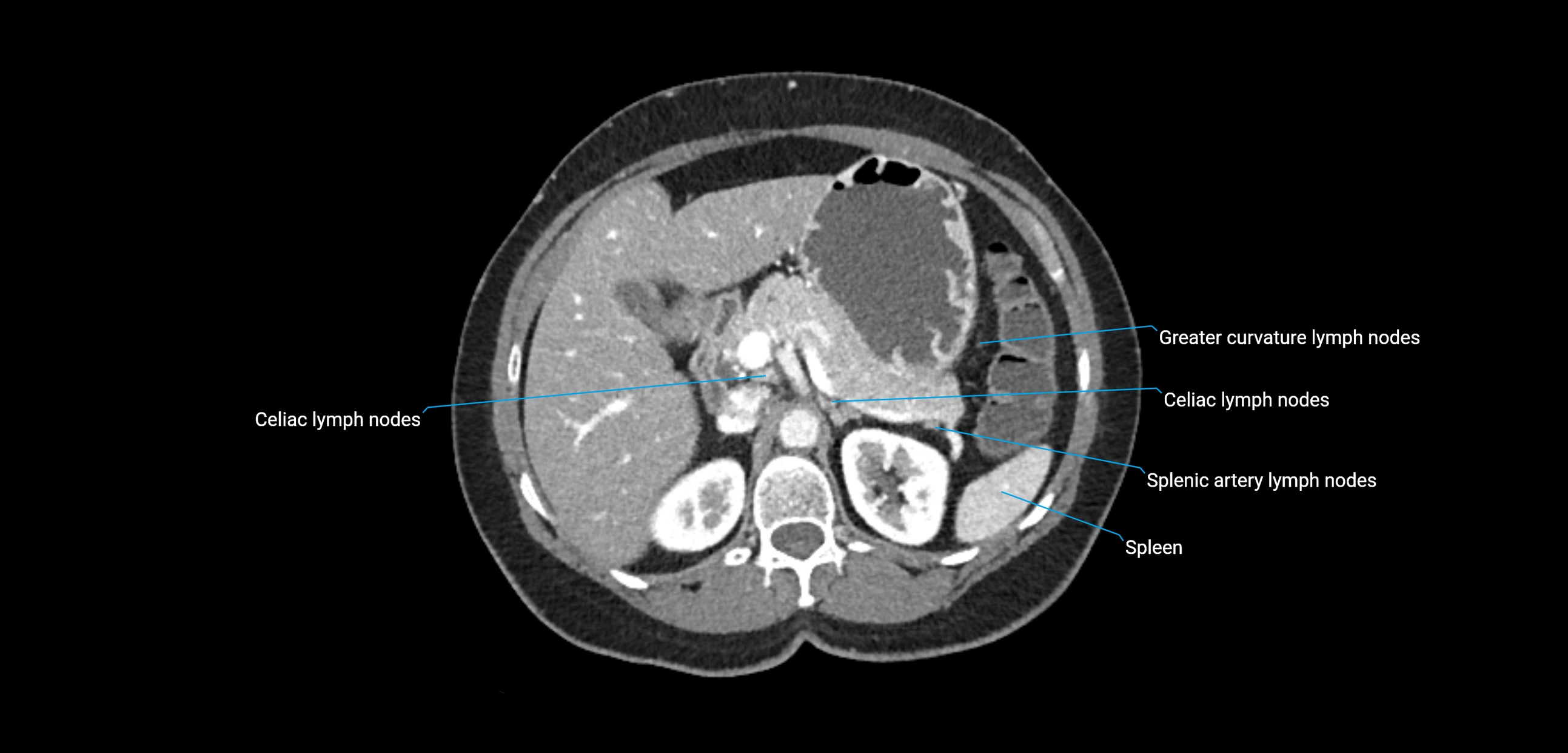 CT ct abdominal lymph nodes  axial cross sectional anatomy  enchanced radiology image -img-00002-00147.webp